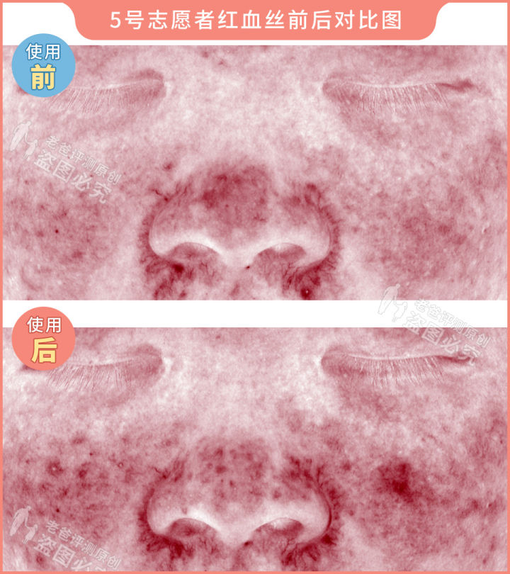 网红家用美容仪真的有效吗？2个多月的跟踪实测结果来了