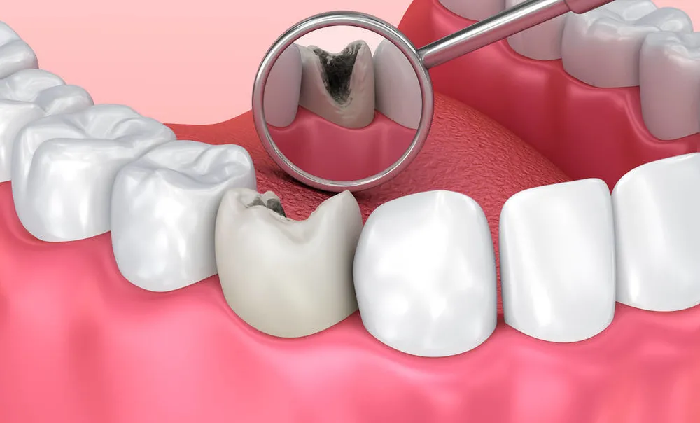 10个人9个有口腔问题，测一测你的“蛀牙、掉牙风险”有多少？