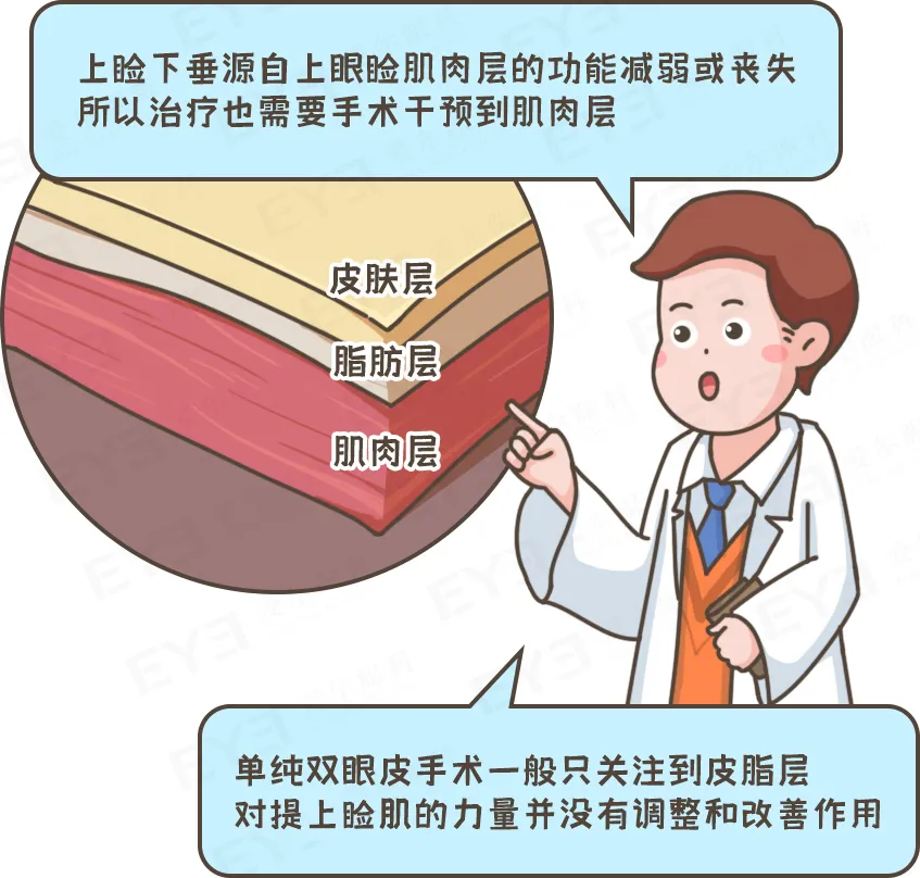 眼皮没力气，不是“睡不醒”，而是“上睑下垂”这种病