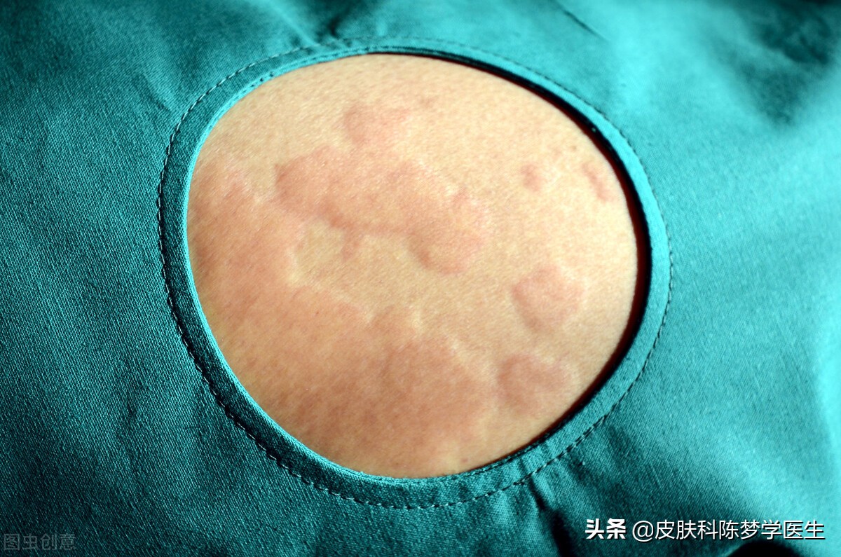 痒！痒！痒！得了荨麻疹，该怎么办？