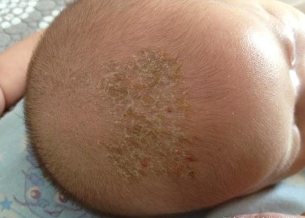 有种"坑娃"叫抠婴儿乳痂,家长顺眼了,孩子却受罪了