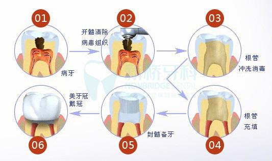 抽完牙神经后，牙齿变成“死牙”？还能要吗？