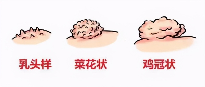 位置:整个生殖器(包括阴茎,龟头,尿道口,阴囊等)以及肛周.