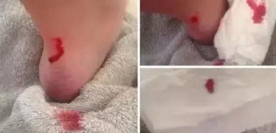 鞋子磨脚怎么办？7个妙招轮一遍，分分钟让你舒适的像穿拖鞋！