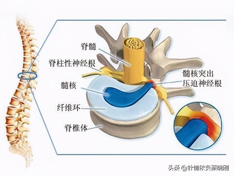 椎间盘突出能拔罐吗(委中穴点刺拔火罐治疗椎间盘突出症)