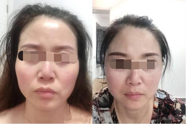 女生遇上面部凹陷，不仅是显老的问题！整形医生教你怎么正确应对