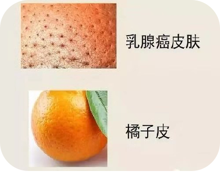 乳房自检，你学会了吗？