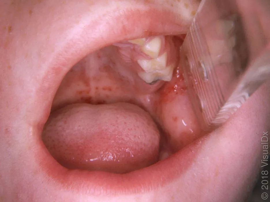 口腔麻疹粘膜斑图片