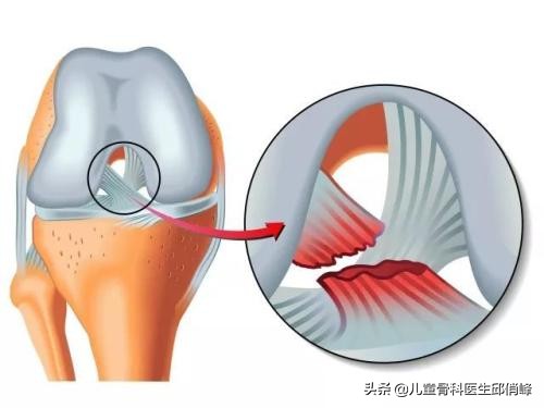 遭遇膝盖十字韧带撕裂(十字韧带撕裂有多严重？至少恢复半年以上)