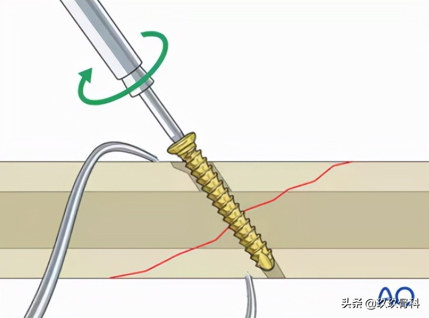 拉力螺钉使用的小技巧