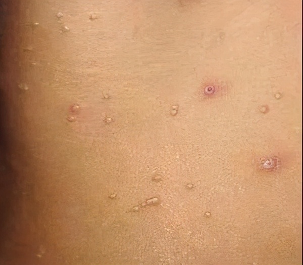 皮脂腺瘤图片(皮肤上长了小肉球) - 赤虎壹号