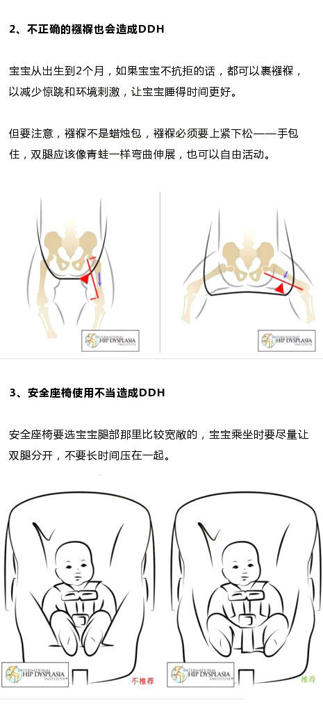 医生提醒：宝宝臀纹不对称，要及时就医！1岁后发现就晚了