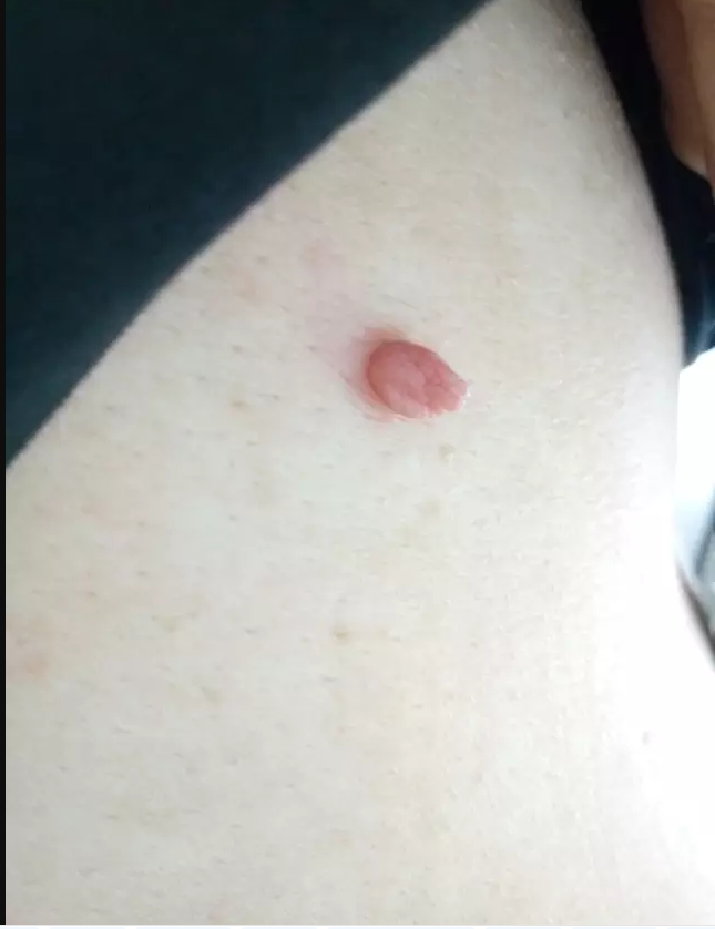 颈部长小肉球，抠掉会怎么样，如何处理，医生给你说明白了
