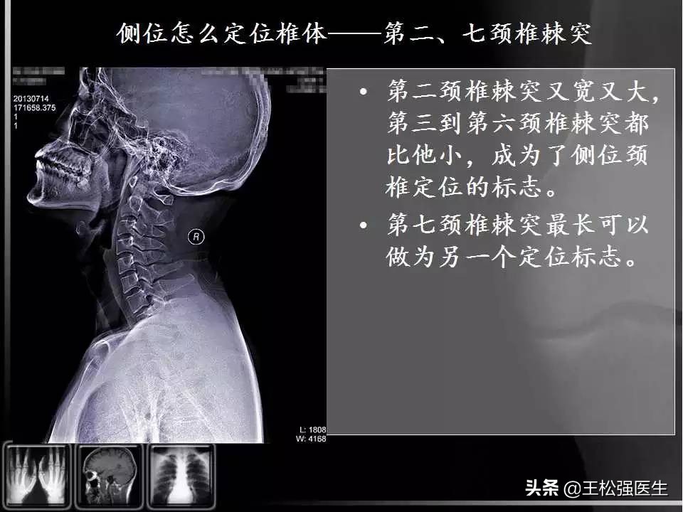 颈椎X光片