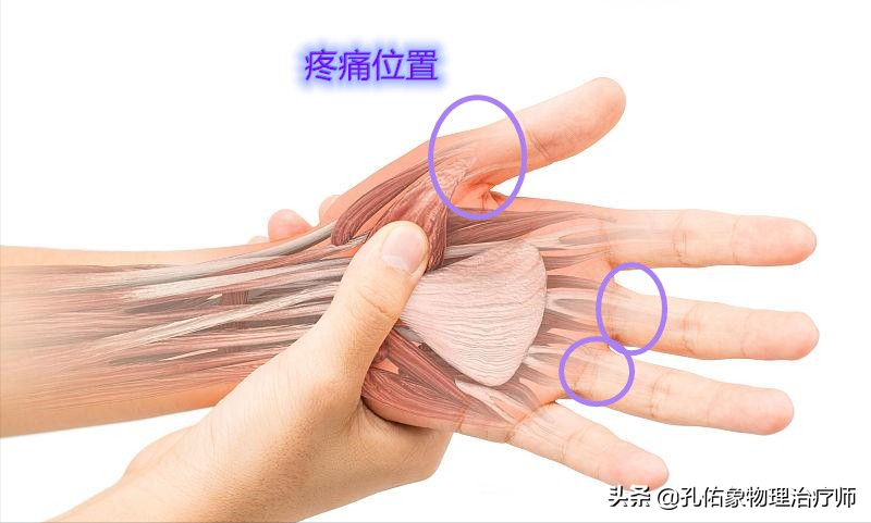 手指肿胀、僵硬、疼痛、有结节，挺挺就过去了？辟谣，趁早诊治