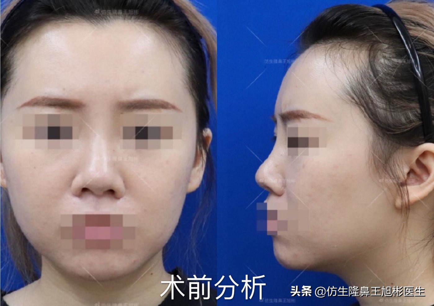 如何定义短鼻，短鼻延长后的改变有多大？