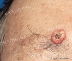 聊一聊：你熟悉的“痦子”