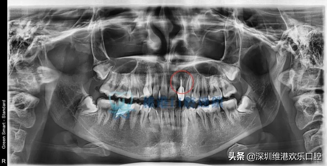 根尖囊肿免费公益筛查，防止牙槽骨破坏和脸部畸形