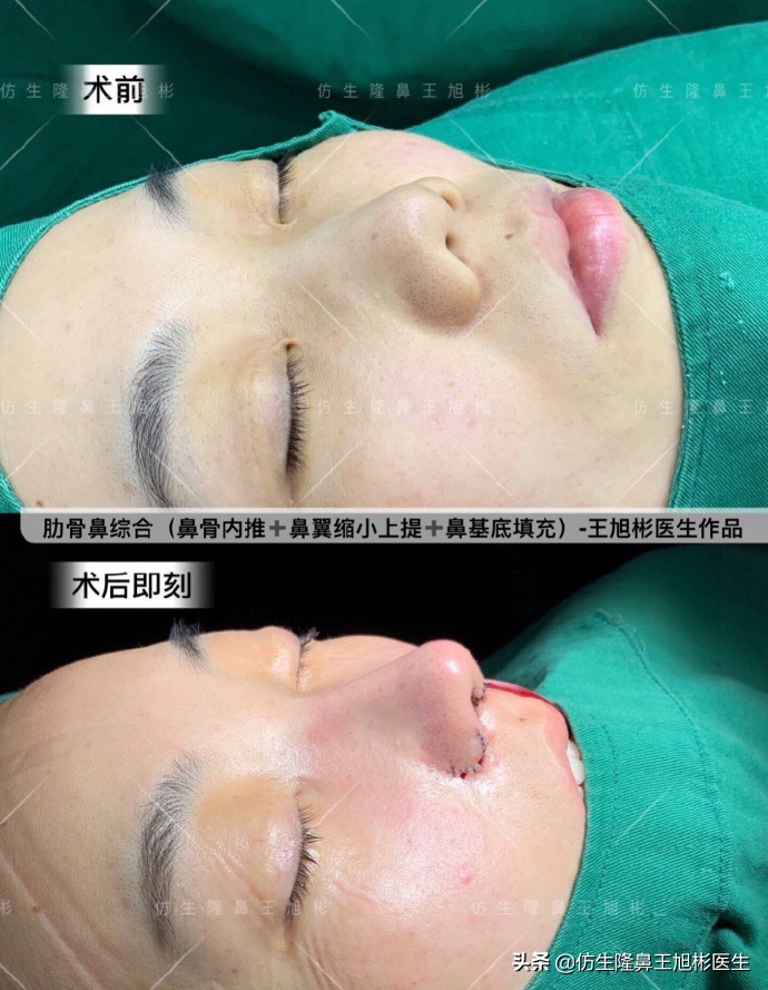 如何定义短鼻，短鼻延长后的改变有多大？