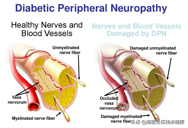 糖尿病周围神经病变，吃甲钴胺就够了？这3种药物，是它的好搭档