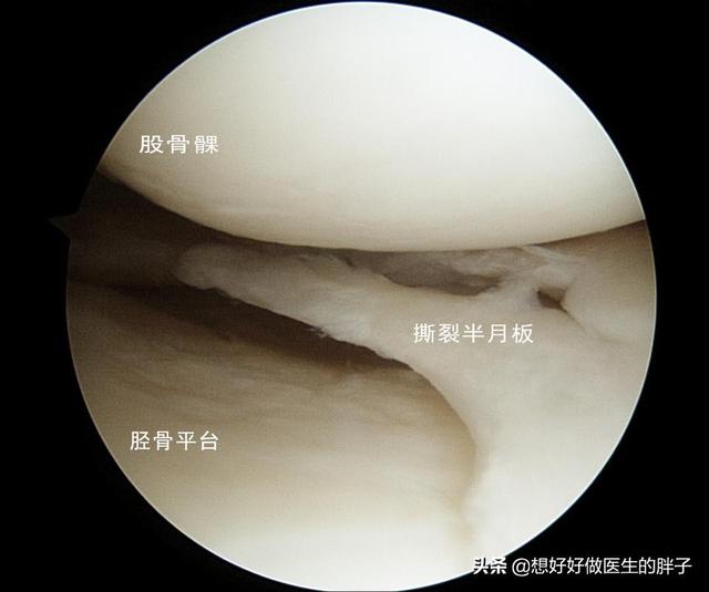 做完半月板手术还能跑步吗(青少年关节镜手术两个月能跳绳和跑步吗？医生：具体问题具体分析)