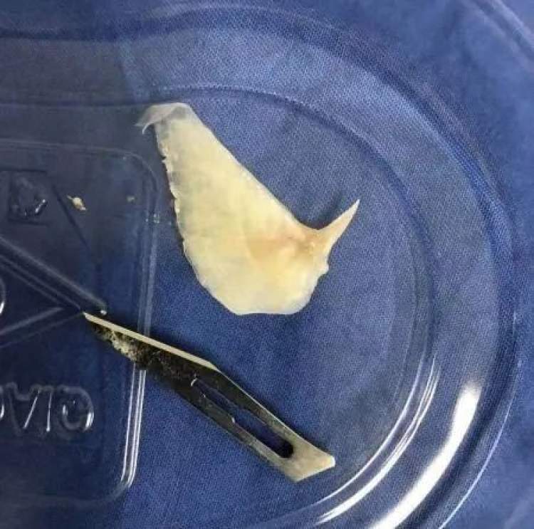 4厘米长黑鱼骨卡喉咙，鱼刺卡在牙齿缝怎么办？