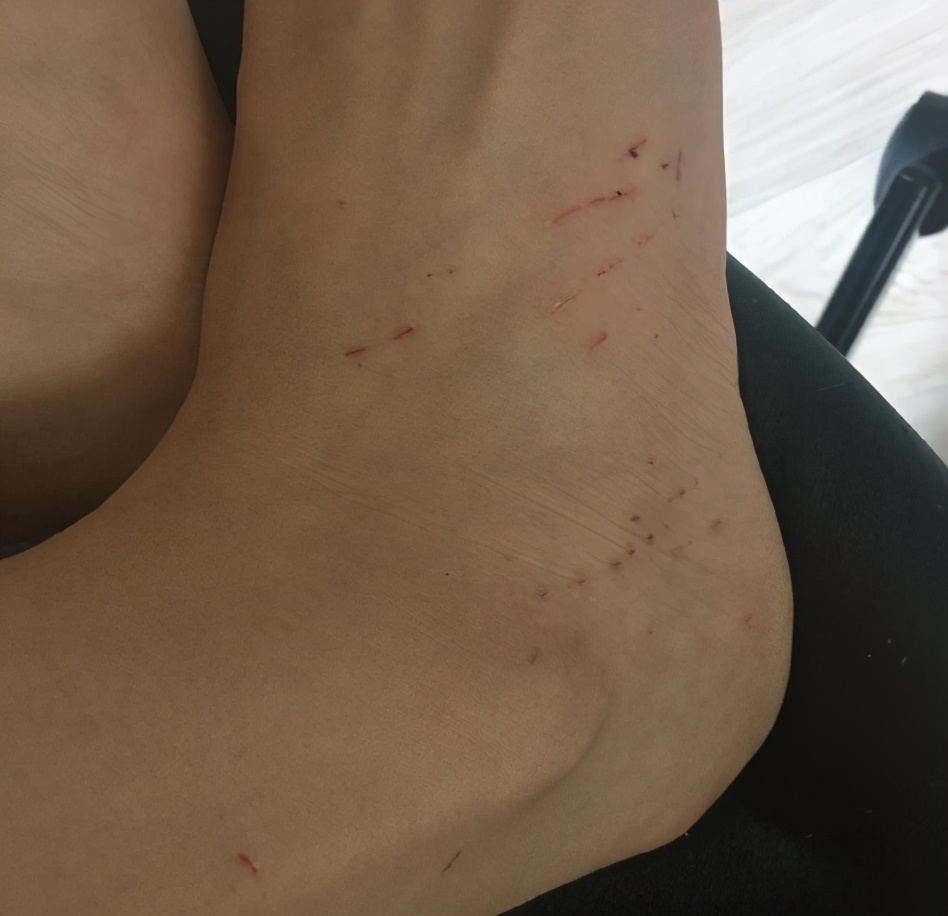 窦佳嫄未成年喝酒纹身得厌食症身上布满抓痕是通透还是叛逆