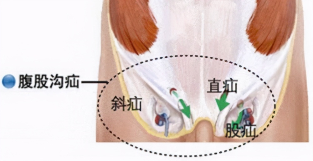 可能是腹股沟疝(当心,有这些症状基本可以确诊为腹股沟疝了)