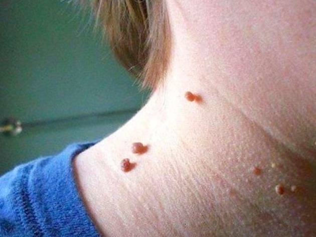 这种情况多发于青年身上,而且女性要比男性更为常见,我们俗称"瘊子"的