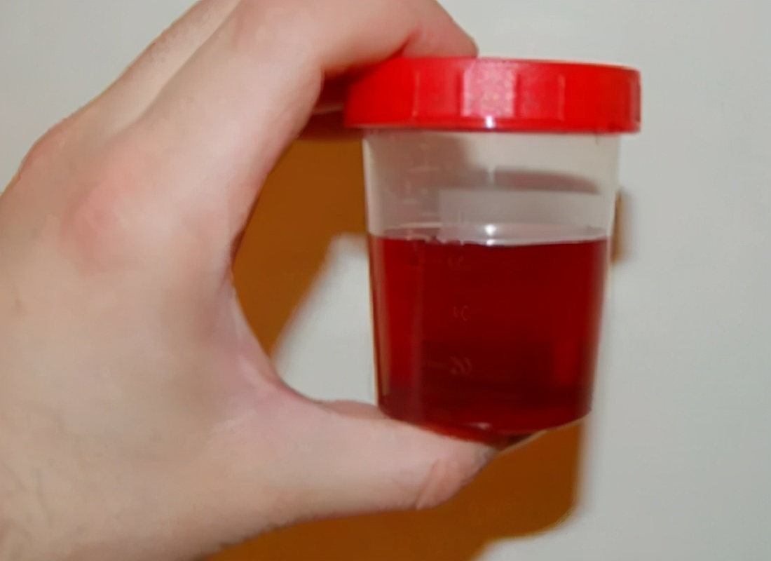 Trace intact blood urine: Urine Test Definition, Disease Detection, and ...