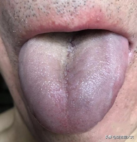 婴儿舌头发紫(老中医讲透舌诊之常见舌象青紫舌舌象高清图谱解说)