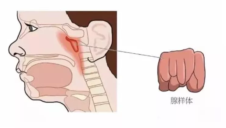 4个月大婴儿腺样体肥大（一文读懂小儿腺样体肥大）