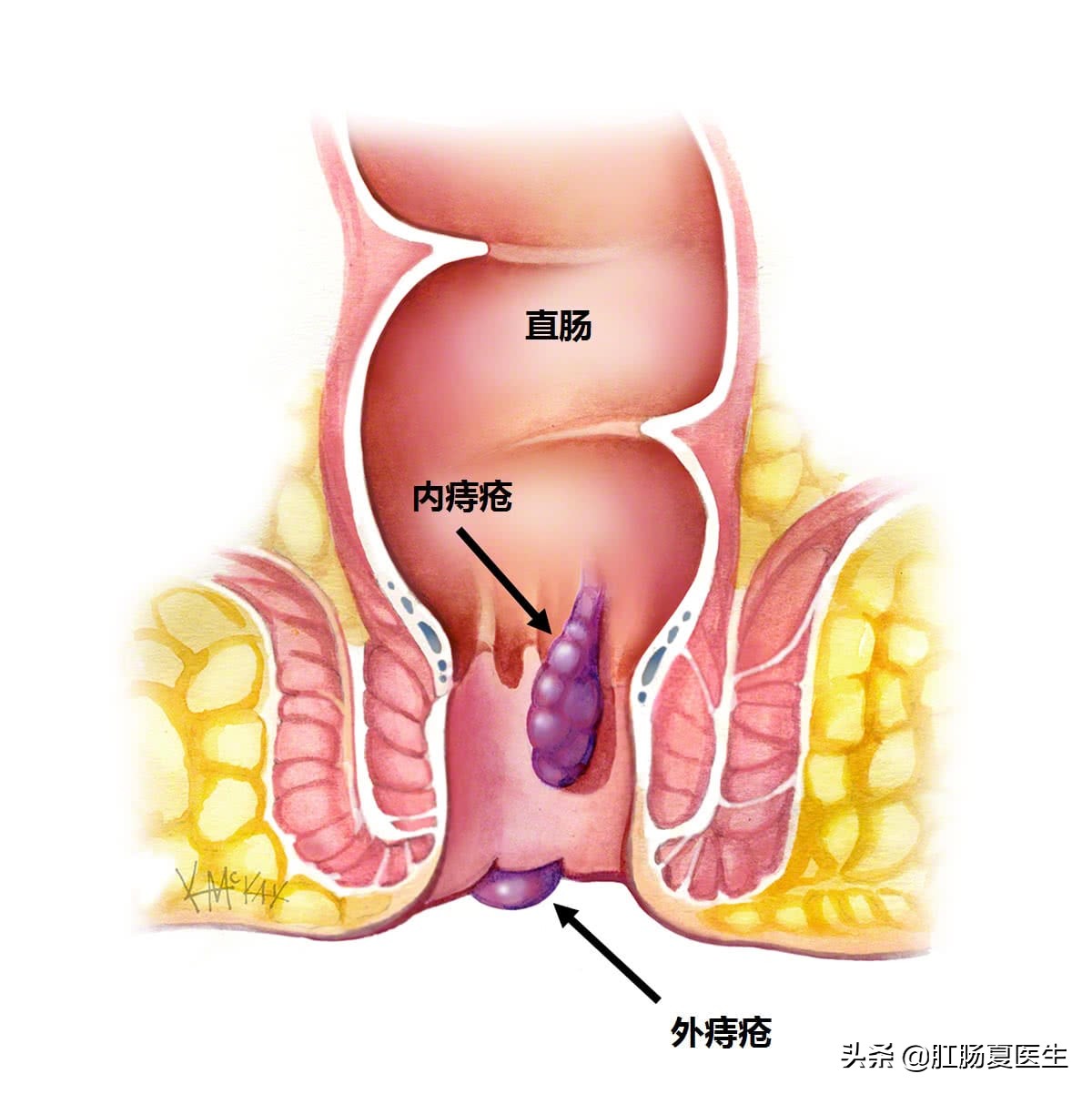 现在的年轻人越来越"野"，竟然自己动手"割"痔疮