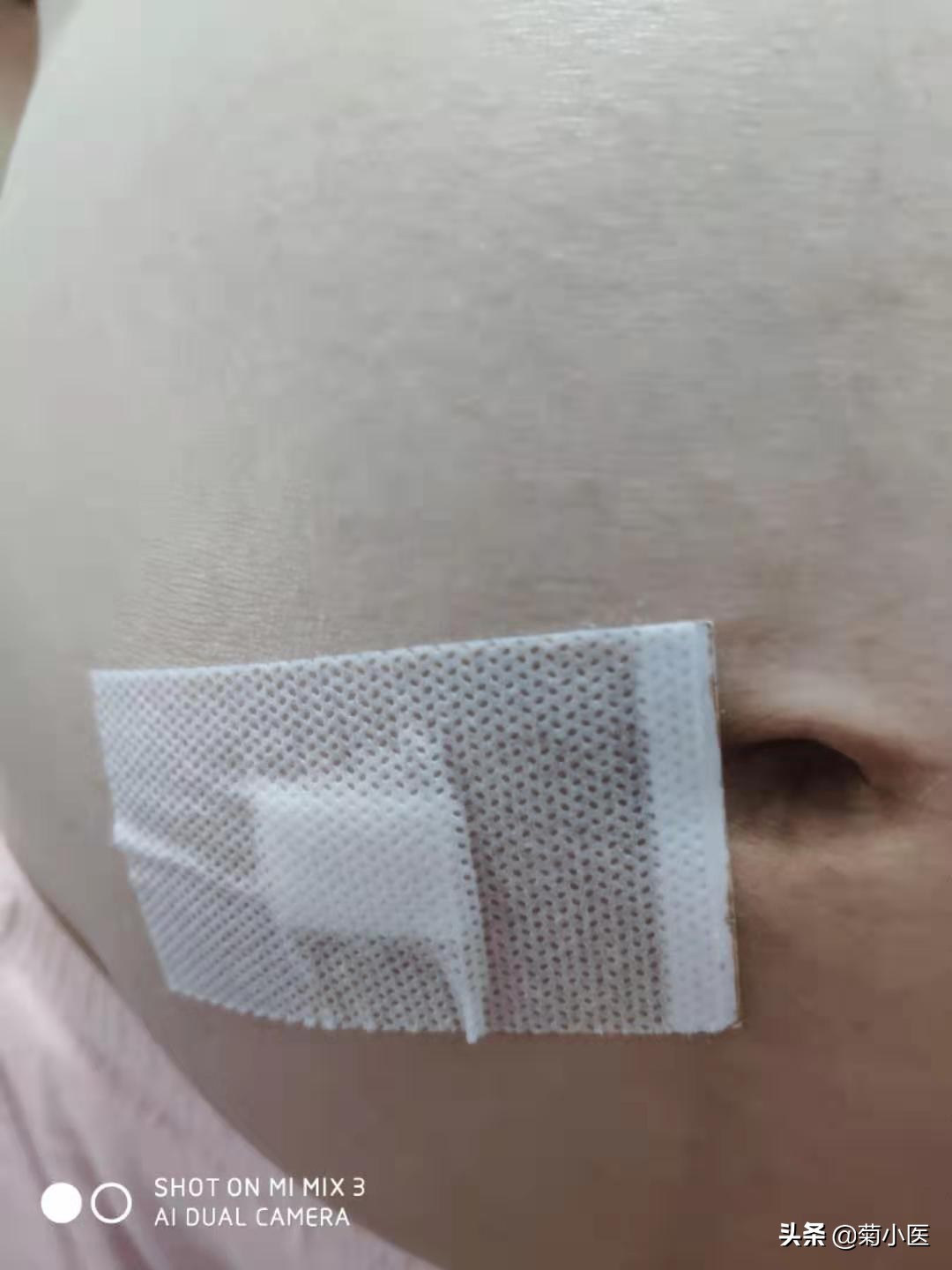 羊水穿刺10分钟，提心吊胆两个月，原来就跟挠痒痒一样......