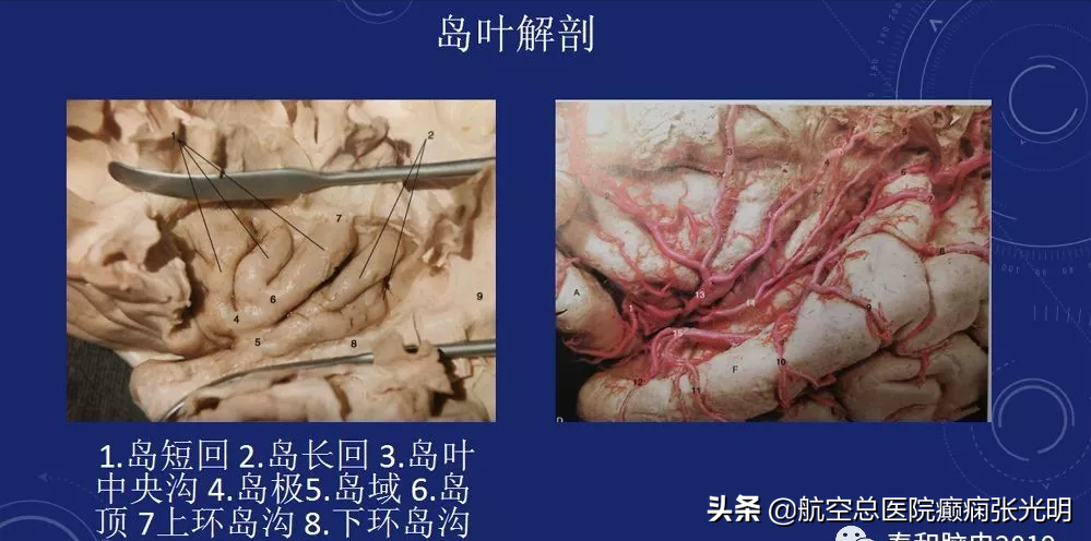 浅谈岛叶癫痫，什么都不像是其症状学特征