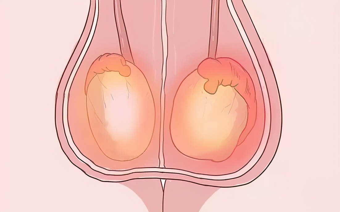 蛋蛋受到损伤的时候,进行超声检查结果常常会提示:睾丸内表面的白膜