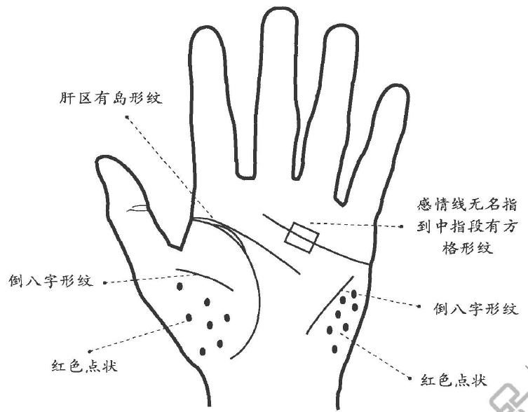 头痛、头眩、双腿沉、腰痛等不能确症，通过掌纹知道原因轻松痊愈