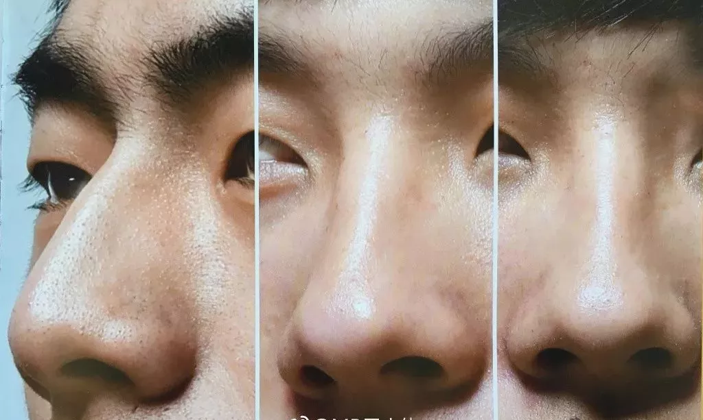 男女隆鼻的相同与差异,体现在哪些方面