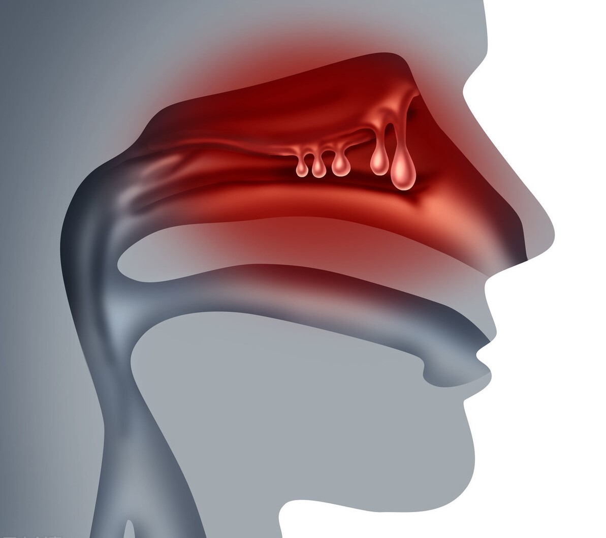 鼻涕由清变黄,说明感冒是变轻还是变重了,是有细菌感染了吗?