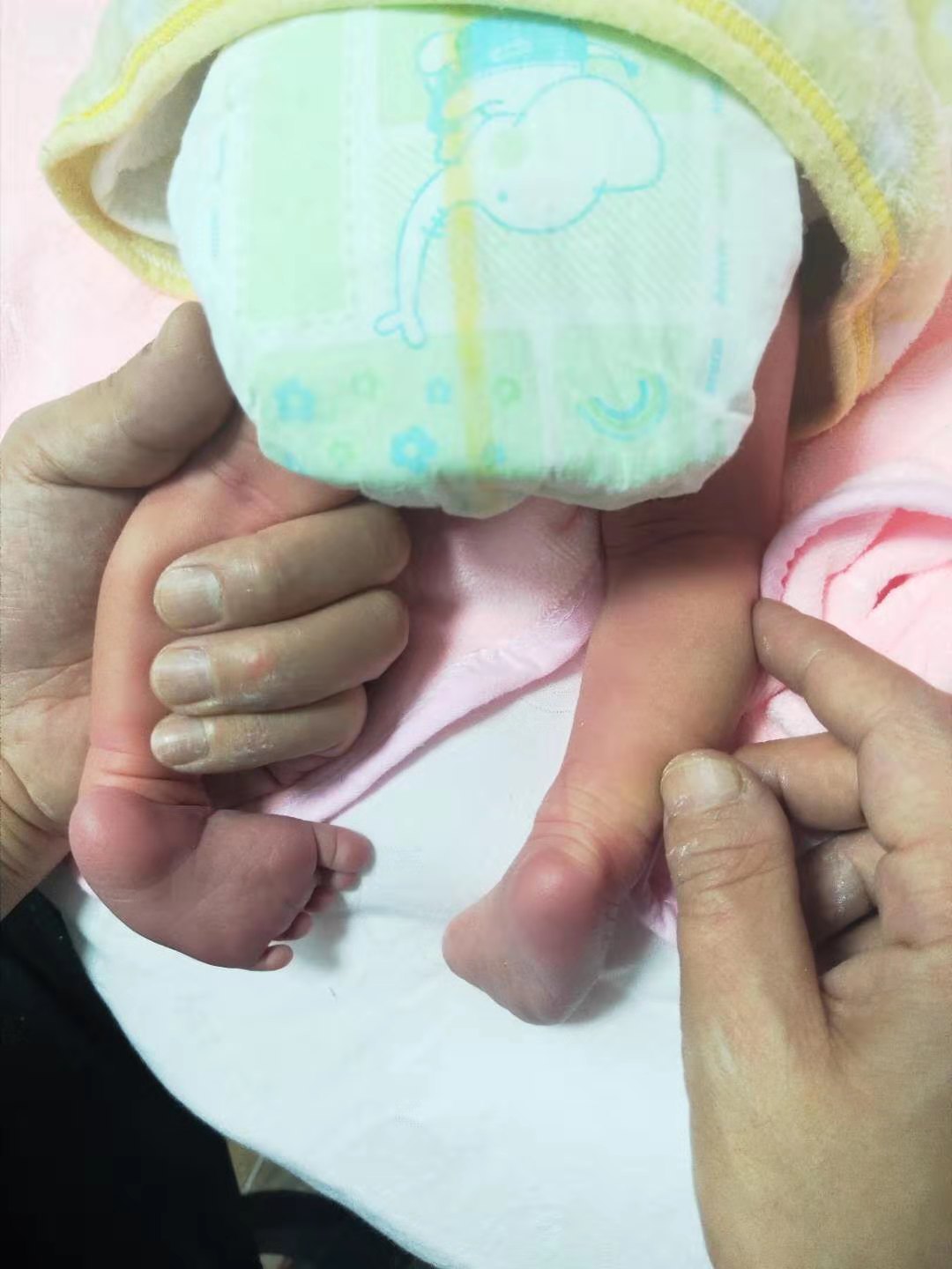 胎儿双足内翻姿势图片图片