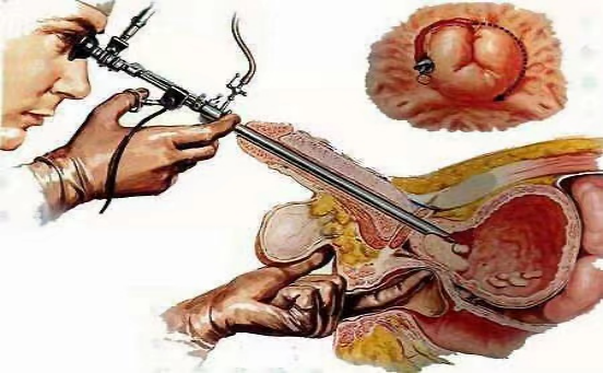 像尿潴留,膀胱结石,上尿路积水等症状就需要通过手术进行治疗了