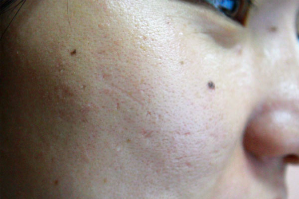 皮肤上的黑痣,会是黑色素瘤吗?