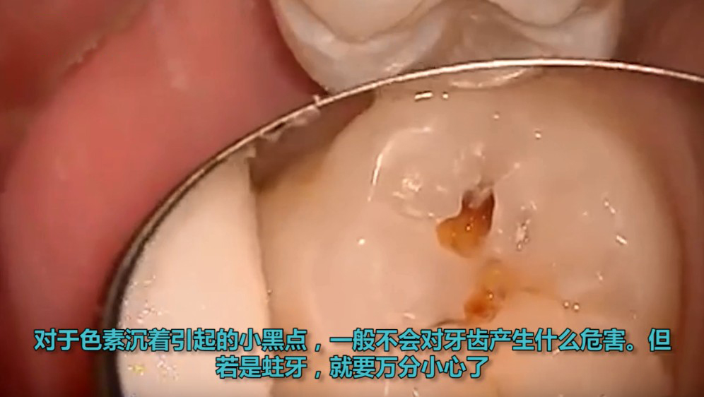 蛀牙初期图片儿童（图文讲解蛀牙的初期样子）