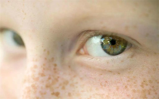 色斑是目前人类面部甚至累及身体躯干上常见的一类面部色素增多性疾病