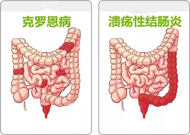 安倍晉三黯然交出日本相位,潰瘍性大腸炎就這麼不好惹?