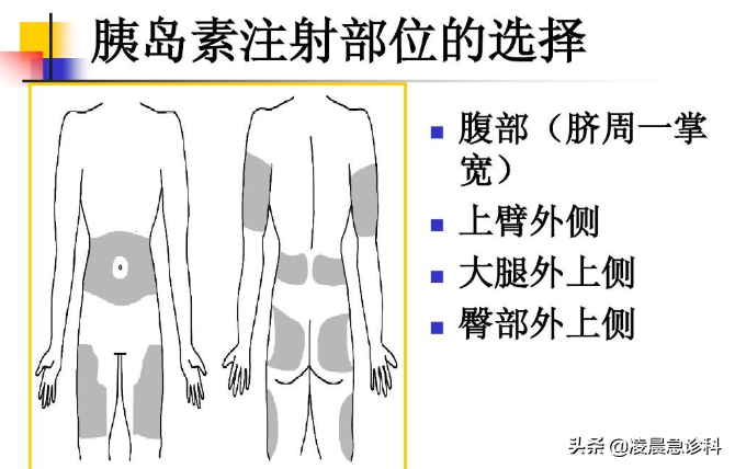 胰岛素只会打肚子？肚子全是针眼没好地，手把手教你如何打胰岛素