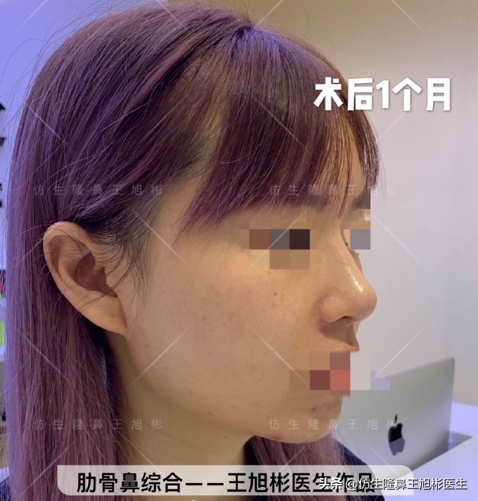 如何定义短鼻，短鼻延长后的改变有多大？