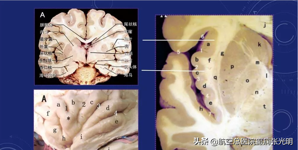 浅谈岛叶癫痫，什么都不像是其症状学特征
