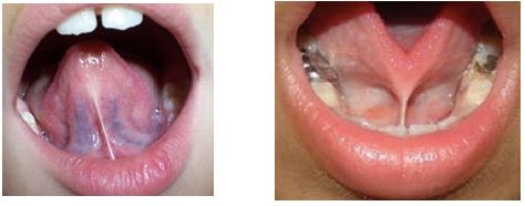 舌系带过短要不要剪?