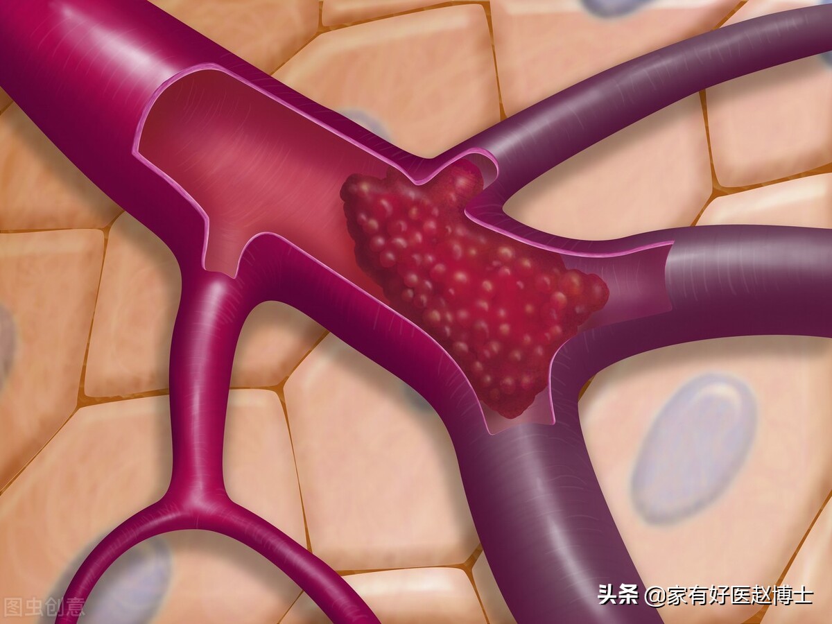 脂蛋白a升高，究竟提示何种风险？“无药可治”，应该如何破解？